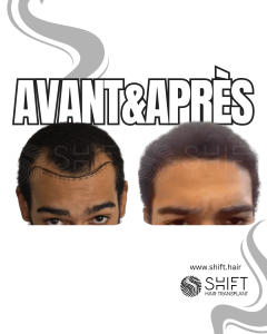 Avant Après une greffe de cheveux afro en Turquie chez SHIFT Hair à Istanbul 07 3
