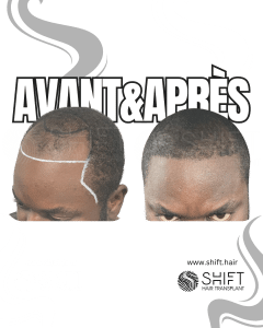 Avant Après une greffe de cheveux afro en Turquie chez SHIFT Hair à Istanbul 08 3