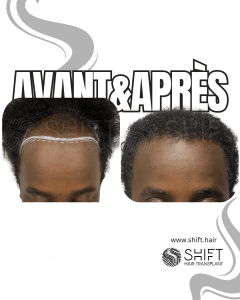 Avant Après une greffe de cheveux afro en Turquie chez SHIFT Hair à Istanbul 10 3