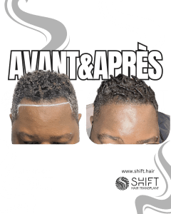 Avant Après une greffe de cheveux afro en Turquie chez SHIFT Hair à Istanbul 11 3