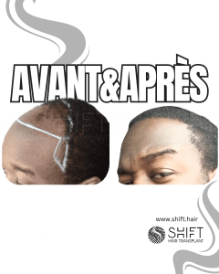 Avant Après une greffe de cheveux afro en Turquie chez SHIFT Hair à Istanbul 14 3
