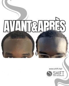 Avant Après une greffe de cheveux afro en Turquie chez SHIFT Hair à Istanbul 15 3