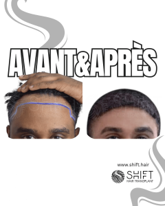 Avant Après une greffe de cheveux afro en Turquie chez SHIFT Hair à Istanbul 16 3