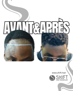 Avant Après une greffe de cheveux afro en Turquie chez SHIFT Hair à Istanbul 17 3