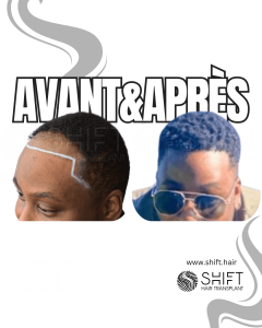 Avant Après une greffe de cheveux afro en Turquie chez SHIFT Hair à Istanbul 18 3