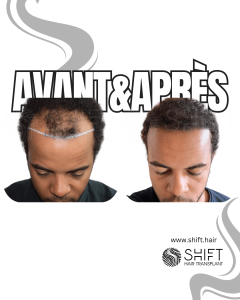Avant Après une greffe de cheveux afro en Turquie chez SHIFT Hair à Istanbul 19 3