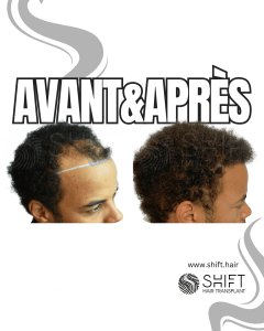 Avant Après une greffe de cheveux afro en Turquie chez SHIFT Hair à Istanbul 20 3