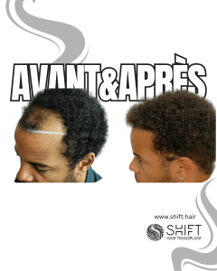 Avant Après une greffe de cheveux afro en Turquie chez SHIFT Hair à Istanbul 21 3