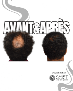 Avant Après une greffe de cheveux afro en Turquie chez SHIFT Hair à Istanbul 22 3