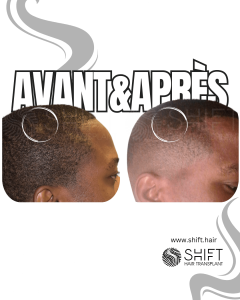 Avant Après une greffe de cheveux afro en Turquie chez SHIFT Hair à Istanbul 23 3
