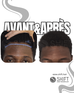 Avant Après une greffe de cheveux afro en Turquie chez SHIFT Hair à Istanbul 24 3
