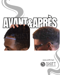 Avant Après une greffe de cheveux afro en Turquie chez SHIFT Hair à Istanbul 25 3