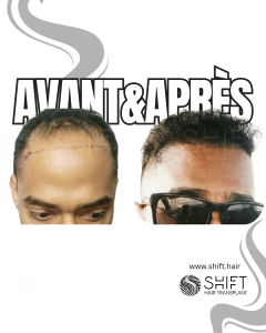 Avant Après une greffe de cheveux afro en Turquie chez SHIFT Hair à Istanbul 26 3