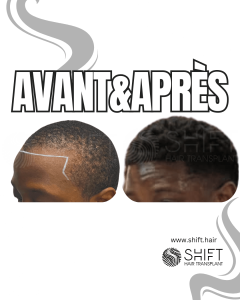 Avant Après une greffe de cheveux afro en Turquie chez SHIFT Hair à Istanbul 28 3