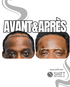 Avant Après une greffe de cheveux afro en Turquie chez SHIFT Hair à Istanbul 29 3