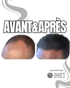 Avant Après une greffe de cheveux afro en Turquie chez SHIFT Hair à Istanbul 30 3