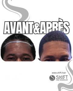 Avant Après une greffe de cheveux afro en Turquie chez SHIFT Hair à Istanbul 32 3