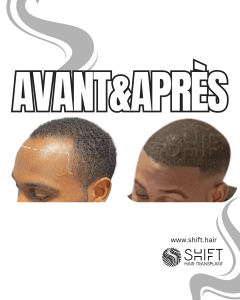 Avant Après une greffe de cheveux afro en Turquie chez SHIFT Hair à Istanbul 34 3