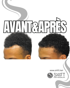 Avant Après une greffe de cheveux afro en Turquie chez SHIFT Hair à Istanbul 36 3