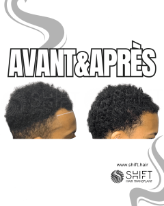 Avant Après une greffe de cheveux afro en Turquie chez SHIFT Hair à Istanbul 37 3