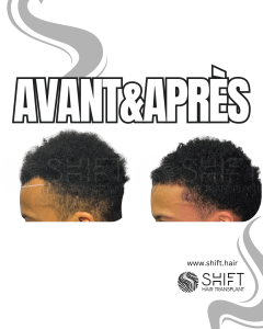 Avant Après une greffe de cheveux afro en Turquie chez SHIFT Hair à Istanbul 38 3