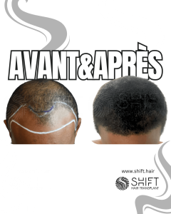 Avant Après une greffe de cheveux afro en Turquie chez SHIFT Hair à Istanbul 39 3