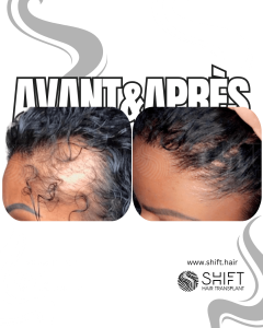 Avant Après une greffe de cheveux afro pour femmes en Turquie chez SHIFT Hair à Istanbul 04 3