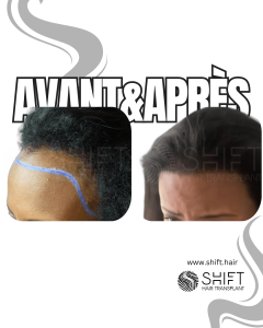 Avant Après une greffe de cheveux afro pour femmes en Turquie chez SHIFT Hair à Istanbul 05 3