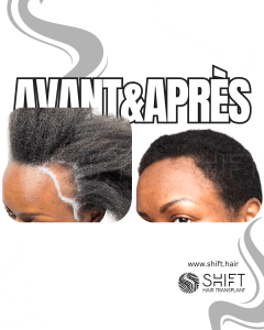 Avant Après une greffe de cheveux afro pour femmes en Turquie chez SHIFT Hair à Istanbul 06 3