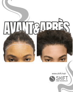 Avant Après une greffe de cheveux pour femmes en Turquie chez SHIFT Hair à Istanbul 01 3