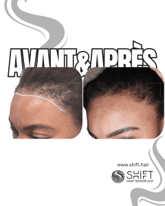 Avant Après une greffe de cheveux pour femmes en Turquie chez SHIFT Hair à Istanbul 02 3