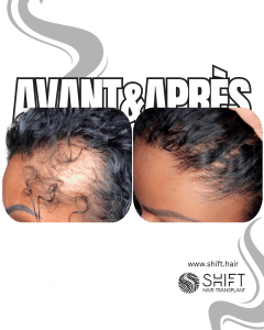 Avant Après une greffe de cheveux pour femmes en Turquie chez SHIFT Hair à Istanbul 04 3