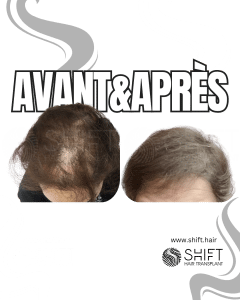 Avant Après une greffe de cheveux pour femmes en Turquie chez SHIFT Hair à Istanbul 06 3