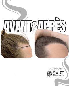 Avant Après une greffe de cheveux pour femmes en Turquie chez SHIFT Hair à Istanbul 07 3