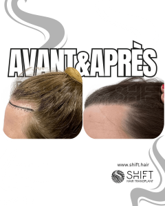 Avant Après une greffe de cheveux pour femmes en Turquie chez SHIFT Hair à Istanbul 08 3