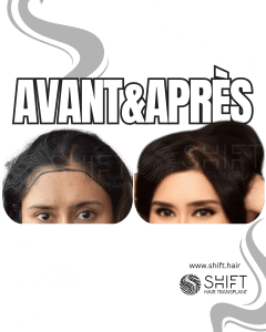 Avant Après une greffe de cheveux pour femmes en Turquie chez SHIFT Hair à Istanbul 10 3