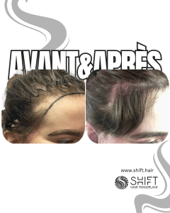 Avant Après une greffe de cheveux pour femmes en Turquie chez SHIFT Hair à Istanbul 12 3