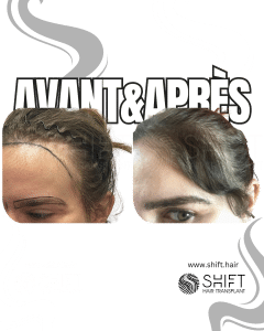 Avant Après une greffe de cheveux pour femmes en Turquie chez SHIFT Hair à Istanbul 13 3