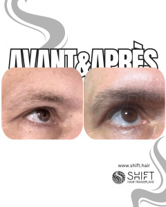 Avant Après une greffe de sourcil pour hommes en Turquie chez SHIFT Hair à Istanbul 01 3
