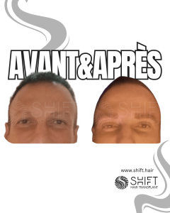 Avant Après une greffe de sourcil pour hommes en Turquie chez SHIFT Hair à Istanbul 02 3