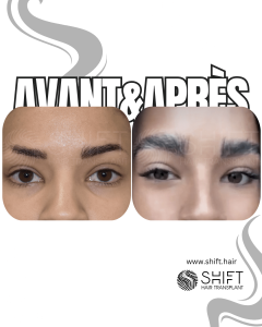 Avant Après une greffe de sourcils afro en Turquie chez SHIFT Hair à Istanbul 01 3