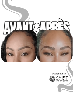 Avant Après une greffe de sourcils afro en Turquie chez SHIFT Hair à Istanbul 02 3