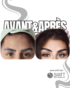 Avant Après une greffe de sourcils en Turquie chez SHIFT Hair à Istanbul 01 3