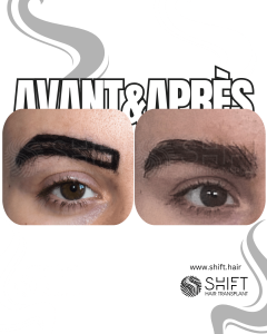 Avant Après une greffe de sourcils en Turquie chez SHIFT Hair à Istanbul 02 3