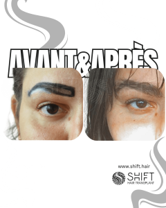 Avant Après une greffe de sourcils en Turquie chez SHIFT Hair à Istanbul 04 3