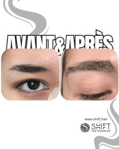 Avant Après une greffe de sourcils en Turquie chez SHIFT Hair à Istanbul 06 3
