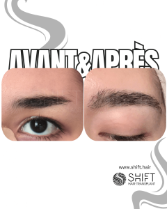 Avant Après une greffe de sourcils en Turquie chez SHIFT Hair à Istanbul 07 3
