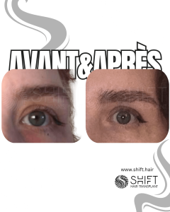 Avant Après une greffe de sourcils en Turquie chez SHIFT Hair à Istanbul 09 3
