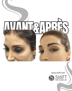 Avant Après une greffe de sourcils en Turquie chez SHIFT Hair à Istanbul 12 3