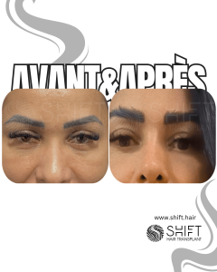 Avant Après une greffe de sourcils en Turquie chez SHIFT Hair à Istanbul 13 3